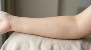 Piqûres et morsures de cafards