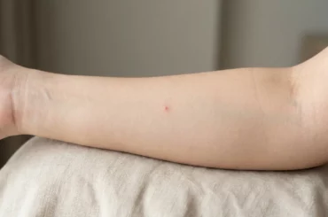 Petite marque rouge isolée sur un avant-bras, aspect d'une morsure de cafard bénigne