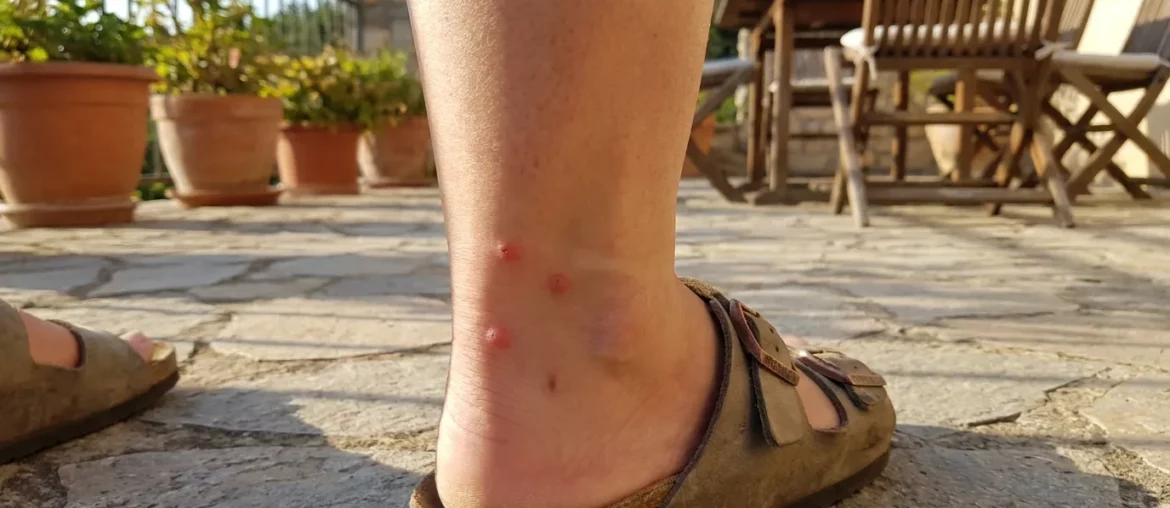 Piqûres de moustique tigre sur une cheville en journée