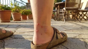 Piqûre de moustique tigre : symptômes et gonflement